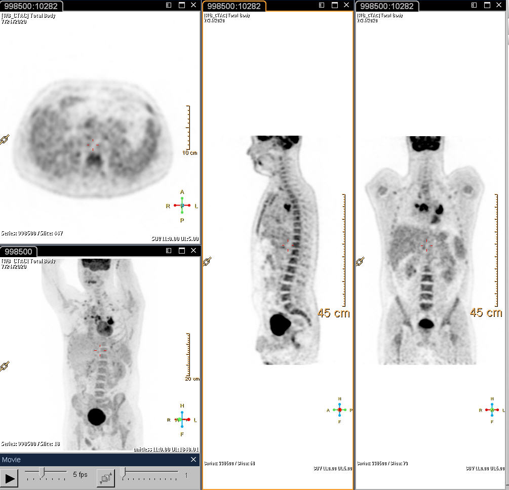 PET/CT Հետազոտություն
