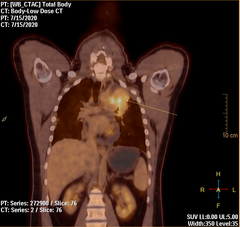 PET/CT Հետազոտություն