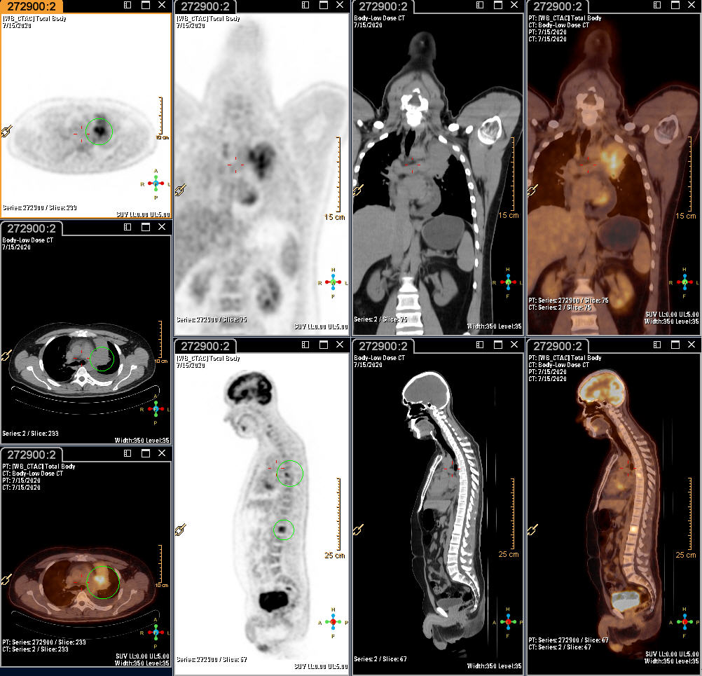 PET/CT Հետազոտություն
