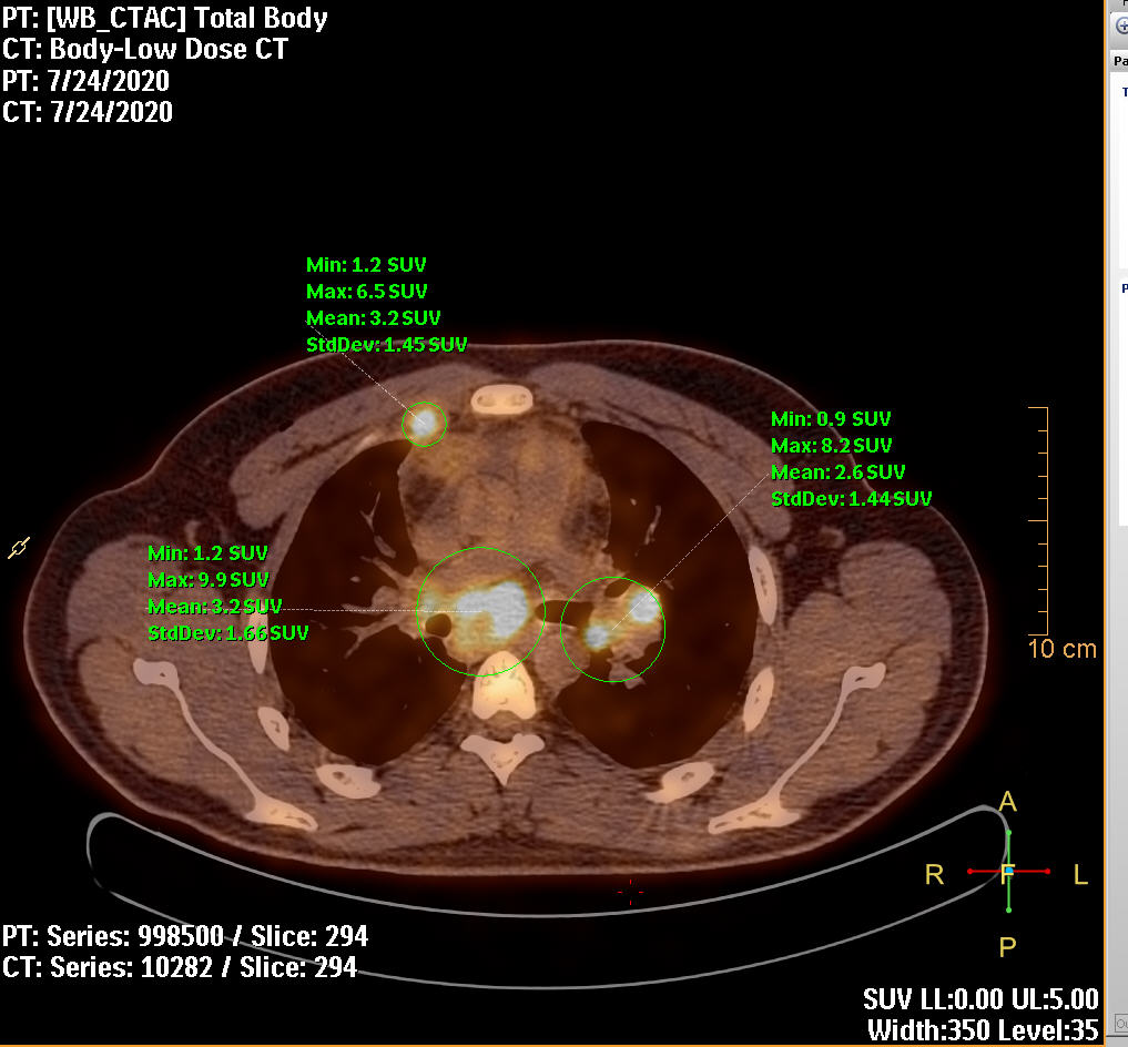 PET/CT scanning